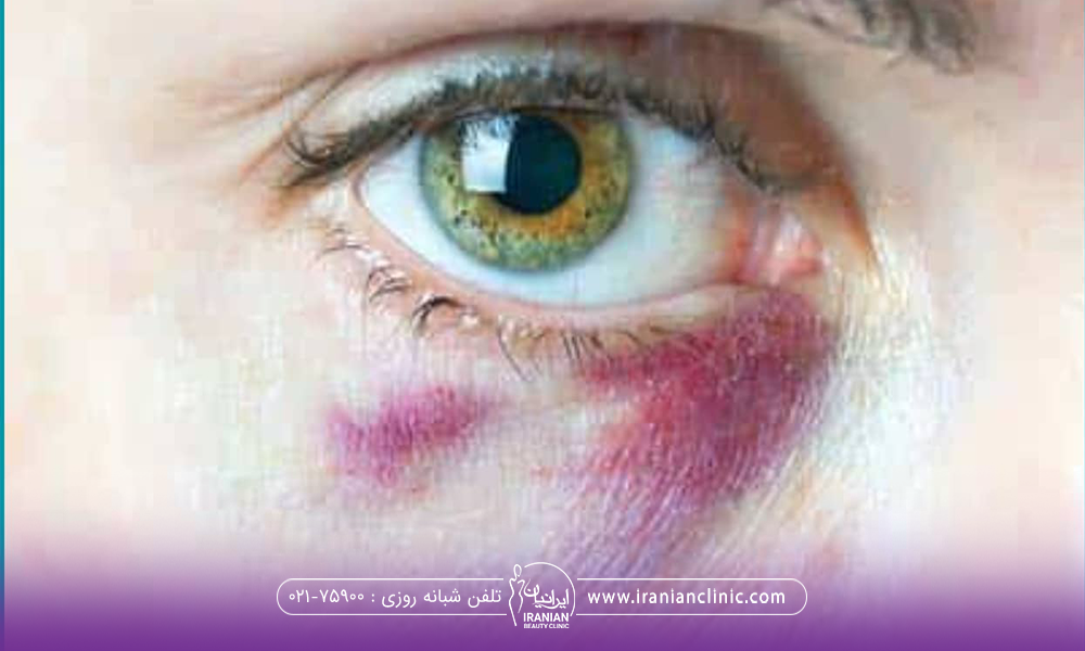 کبودی زیر چشم یک فرد بعد از انجام تزریق ژل 
