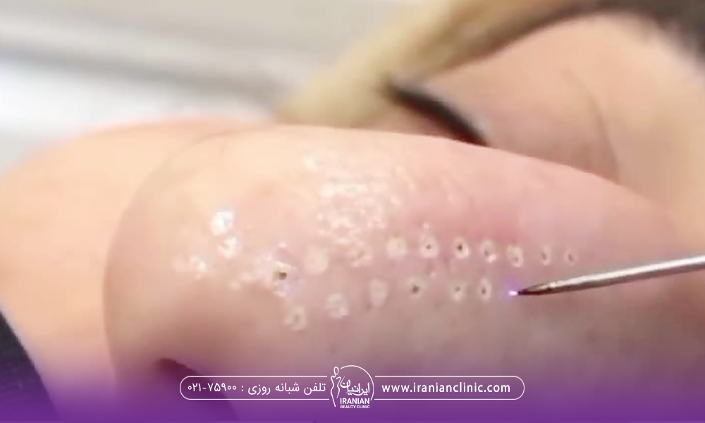 فردی که خوابیده و دستان دکتر در حال انجام پلاسما جت بینی