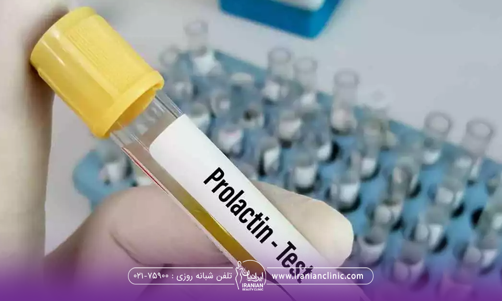 دست دکتری که شیشه نمونه تست پرولاکتین را نگه داشته است