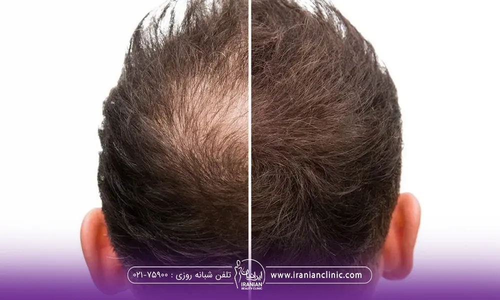 عکس قبل و بعد مردی که ریزش و کم پشتی موی او درمان شده است
