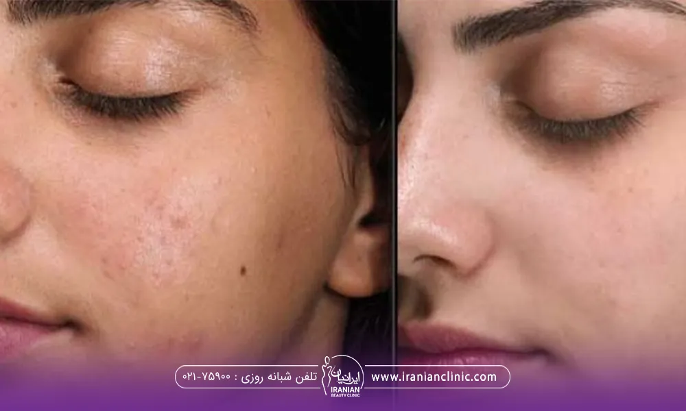 عکس قبل و بعد فردی که فیشیال انجام داده است
