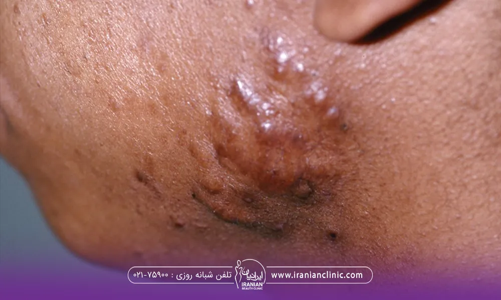 عکس نزدیک از فک فرد که در ناحیه خط فک او ضایعه ای کوچک به شکل کلوئید ایجاد شده است
