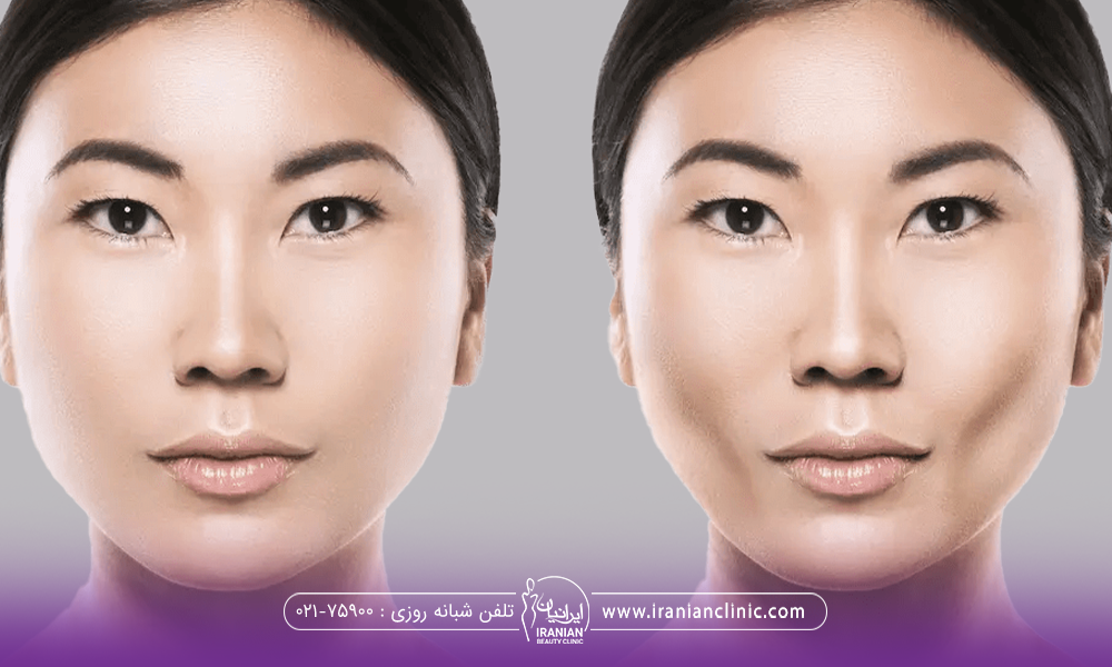 عکس قبل و بعد دختری که عمل بوکال فت انجام داده است