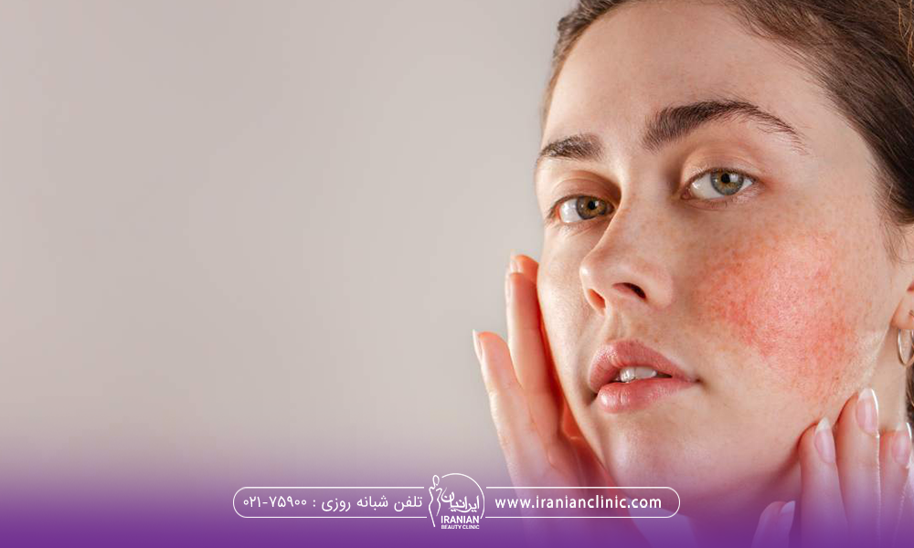 خانم ناراحتی که دو دست خود به دوطرف صورتش است و یک سمت صورتش کاملا قرمز شده است