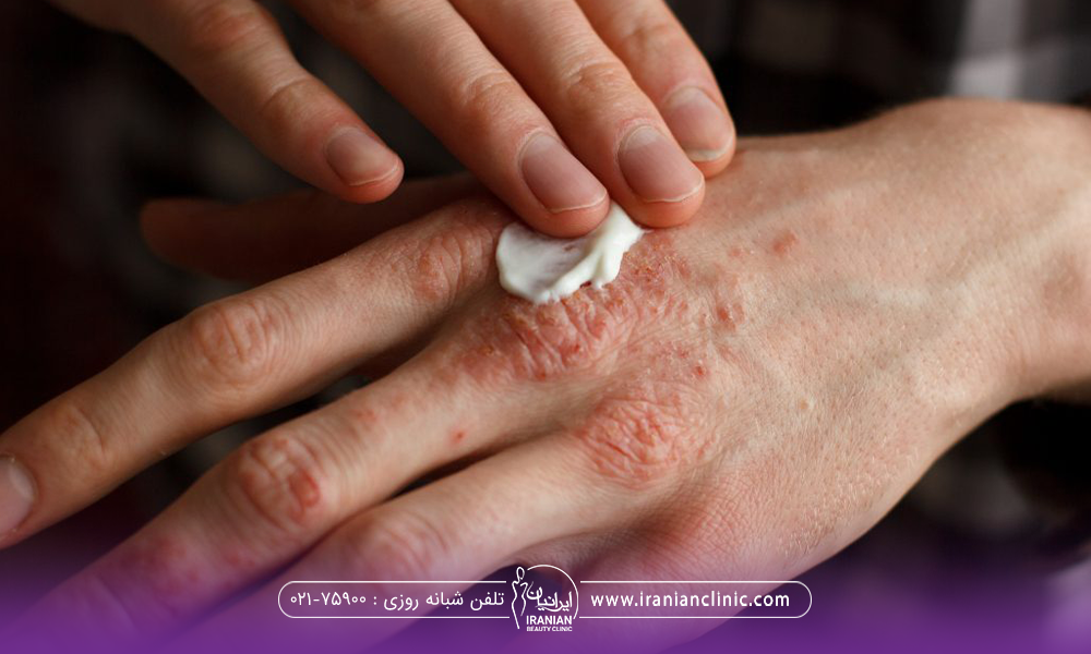 فردی که دست او دچار پسوریازیس شده و روی دستش پماد میزند