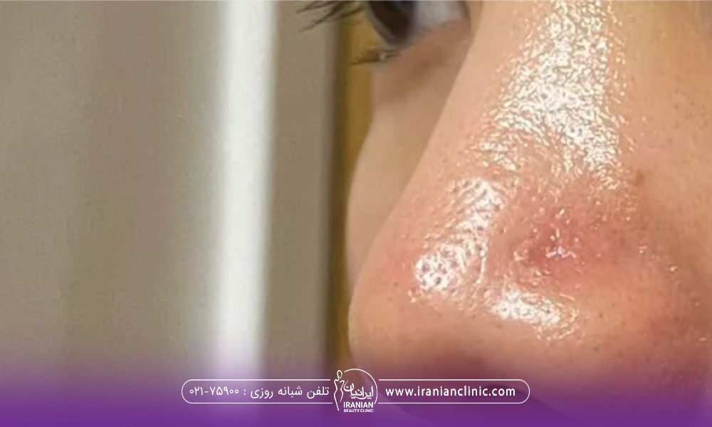 عکس نزدیک از بینی فرد و منافذ باز پوست