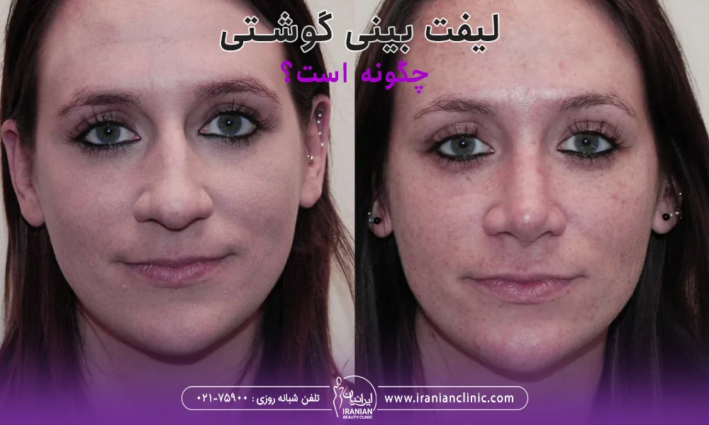 عکس قبل و بعد دختری که بینی گوشتی داشته و لیفت بینی انجام داده است