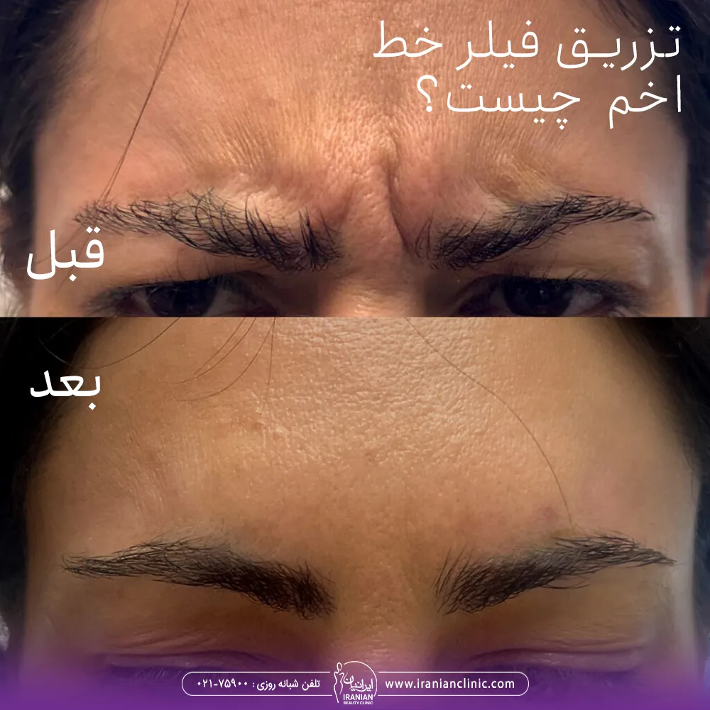 تزریق فیلر خط اخم چیست