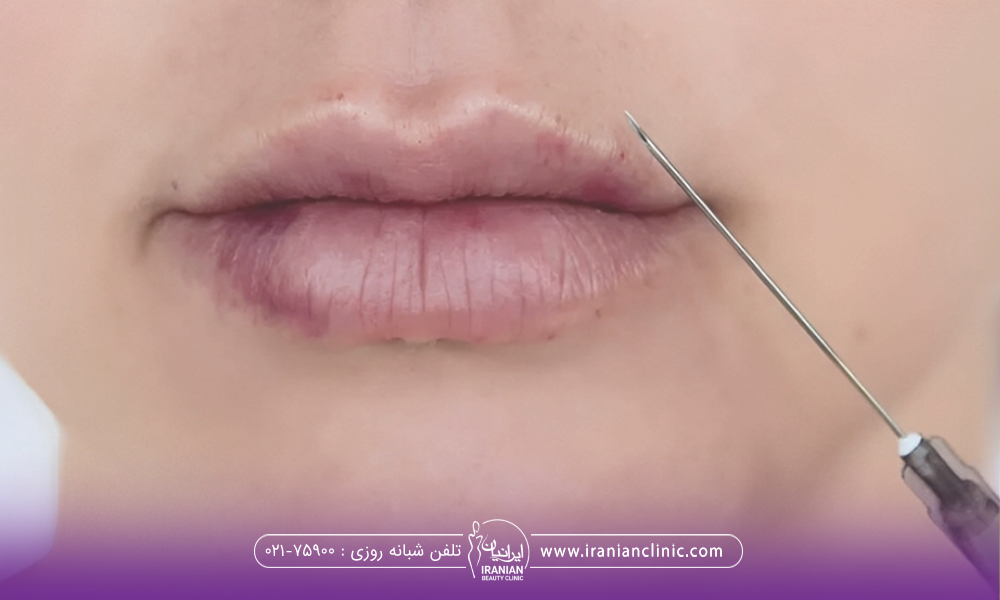 لب یک دختر که سوزن تزریق فیلر به آن نزدیک شده است