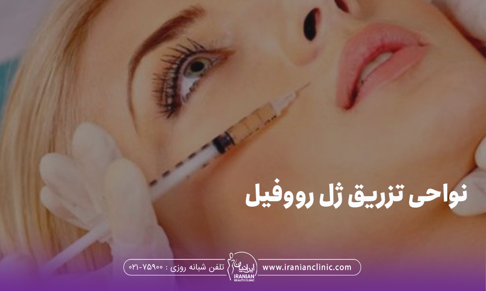 صورت دختری که به خط لبخند او فیلر تزریق می شود و روی عکس نوشته شده نواحی تزریق ژل رووفیل
