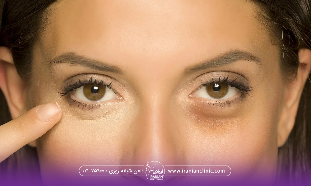 چشم و ابروی فردی که یک سمت صورتش زیر چشمش سیاه است و سمت دیگر شفاف و یک دست است