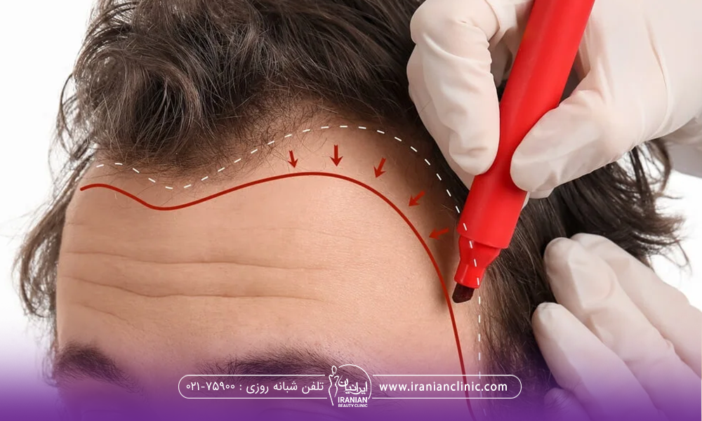 دستان دکتری که روی سر فرد برای انجام کاشت مو شقیقه علامت گذاری میکند