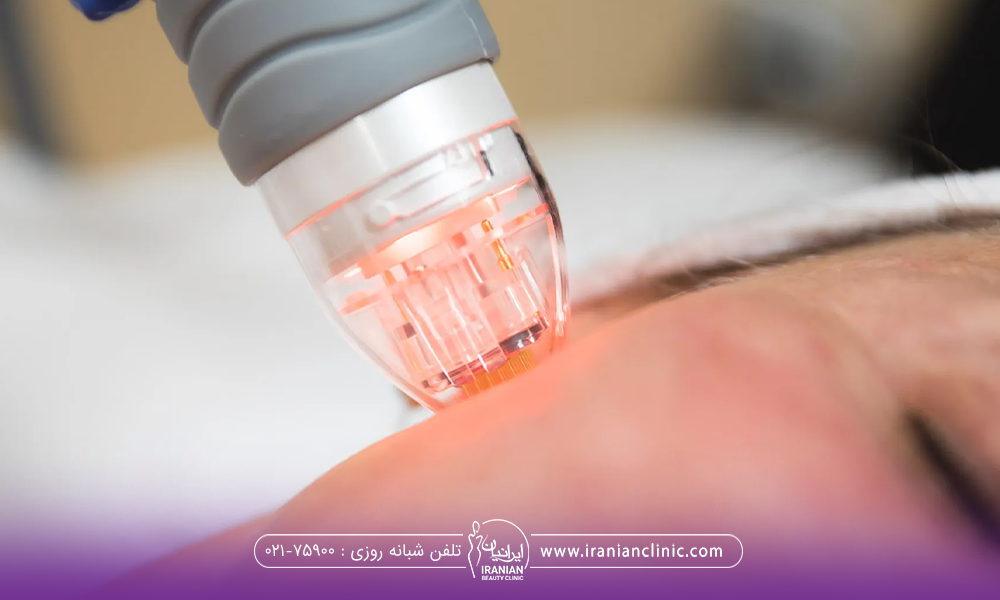 عکس نزدیک از هندپیس آر اف فرکشنال که روی صورت دختر قرار گرفته است