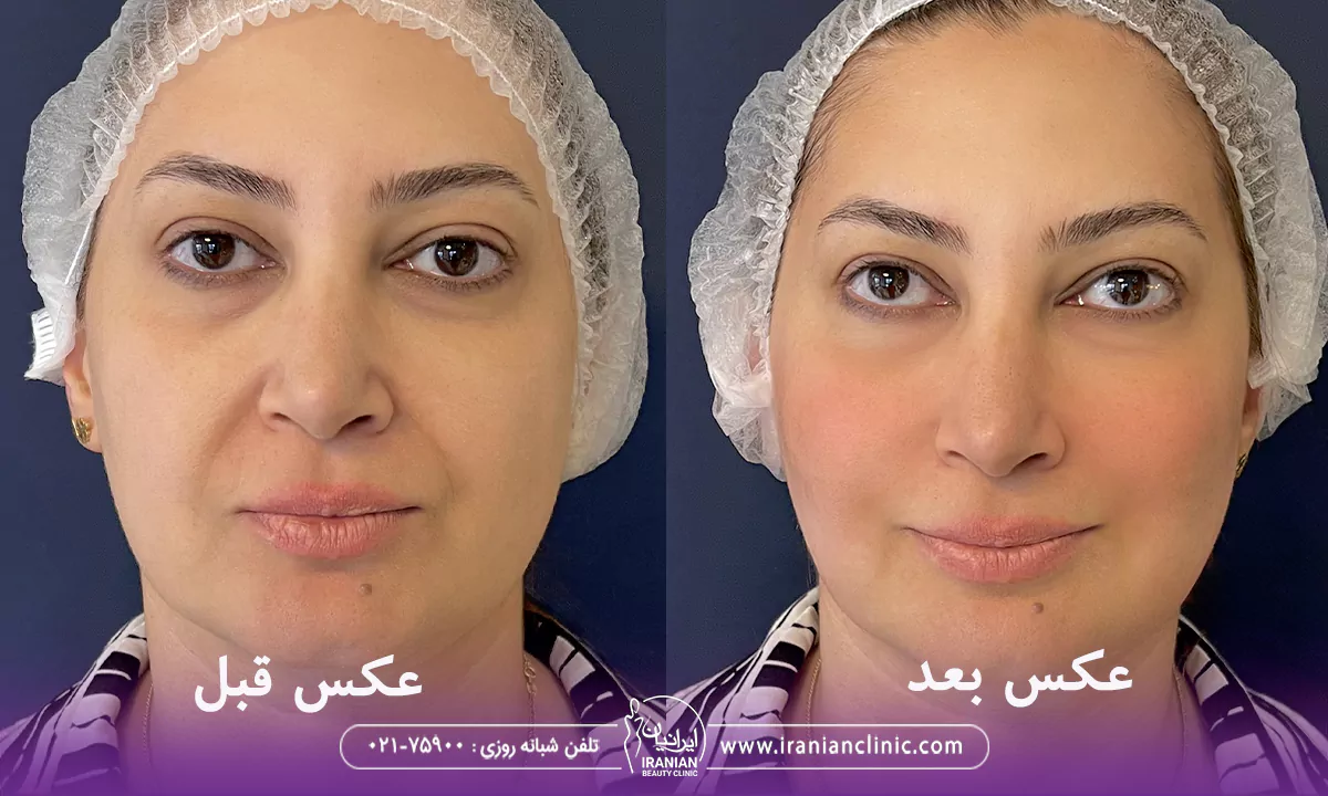 عکس قبل و بعد هایفوتراپی ابرو و صورت