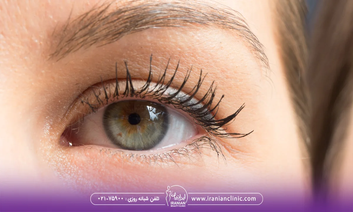 مقایسه قیمت هایفوتراپی دور چشم با نواحی دیگر