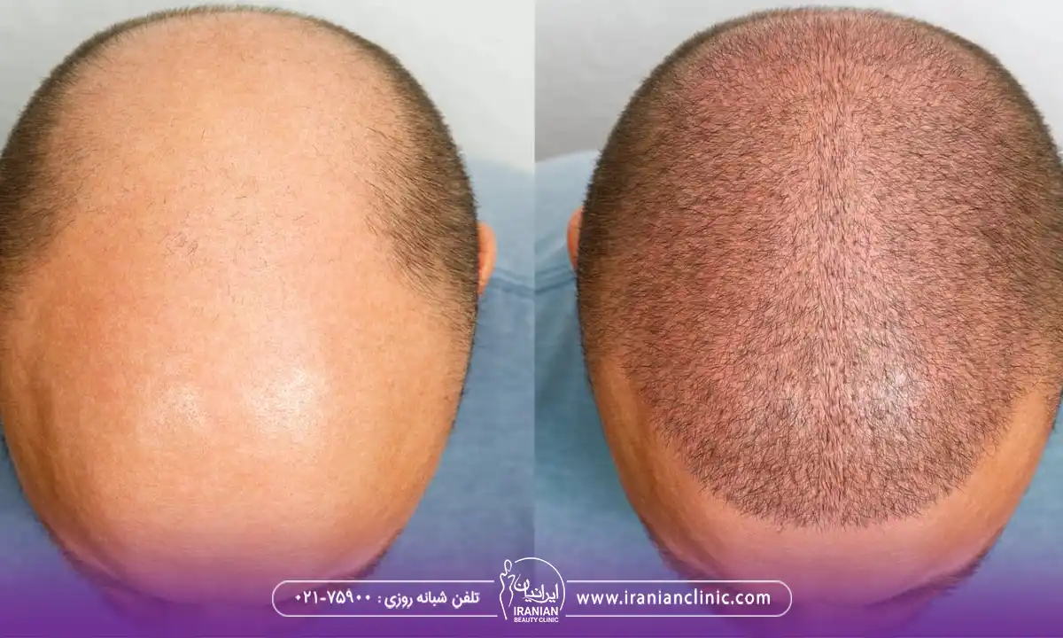 قیمت هر گرافت و هر تار مو در روش FIT