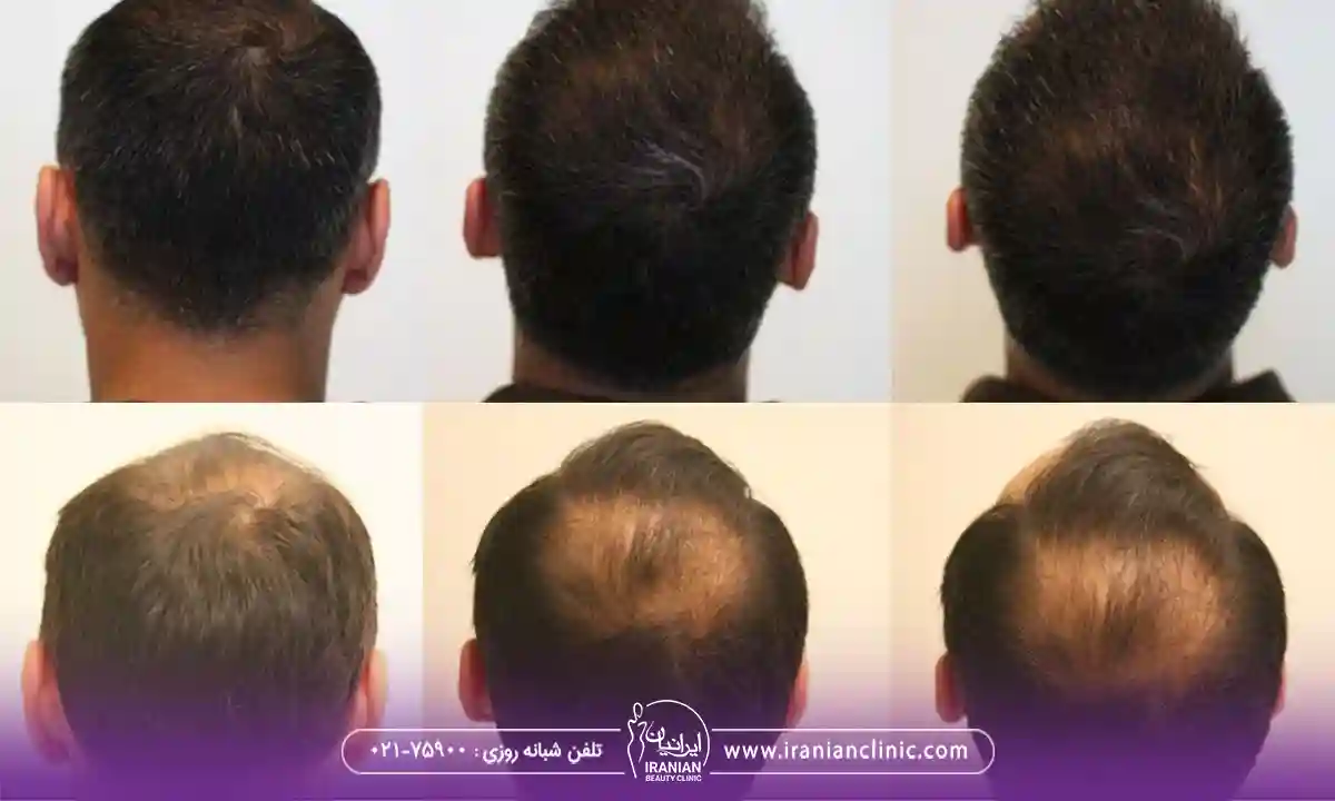 نتیجه واقعی رشد مو بعد کاشت