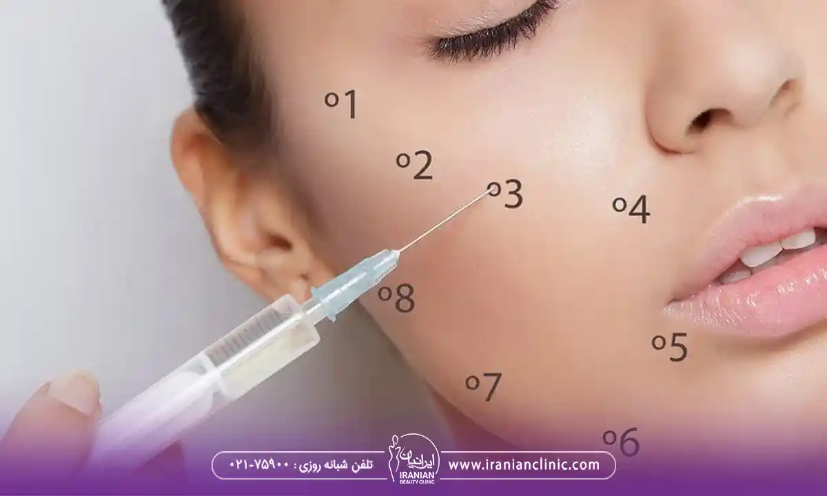 انواع فیلر پلوریال