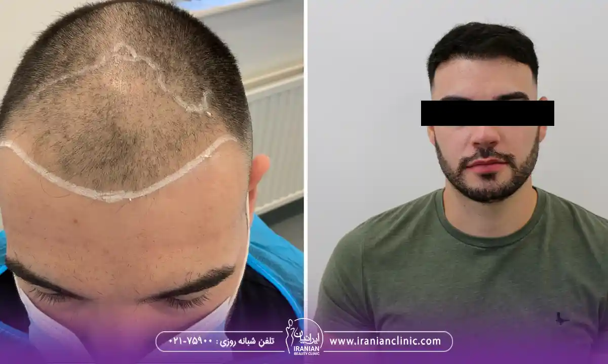 قیمت هر گرافت و هر تار مو به روش تکثیر