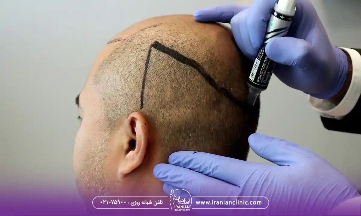 عوامل مؤثر بر هزینه کاشت مو به روش تکثیر