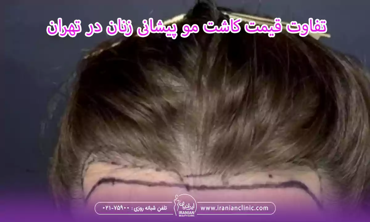 تفاوت قیمت کاشت مو پیشانی زنان در تهران و سایر مناطق