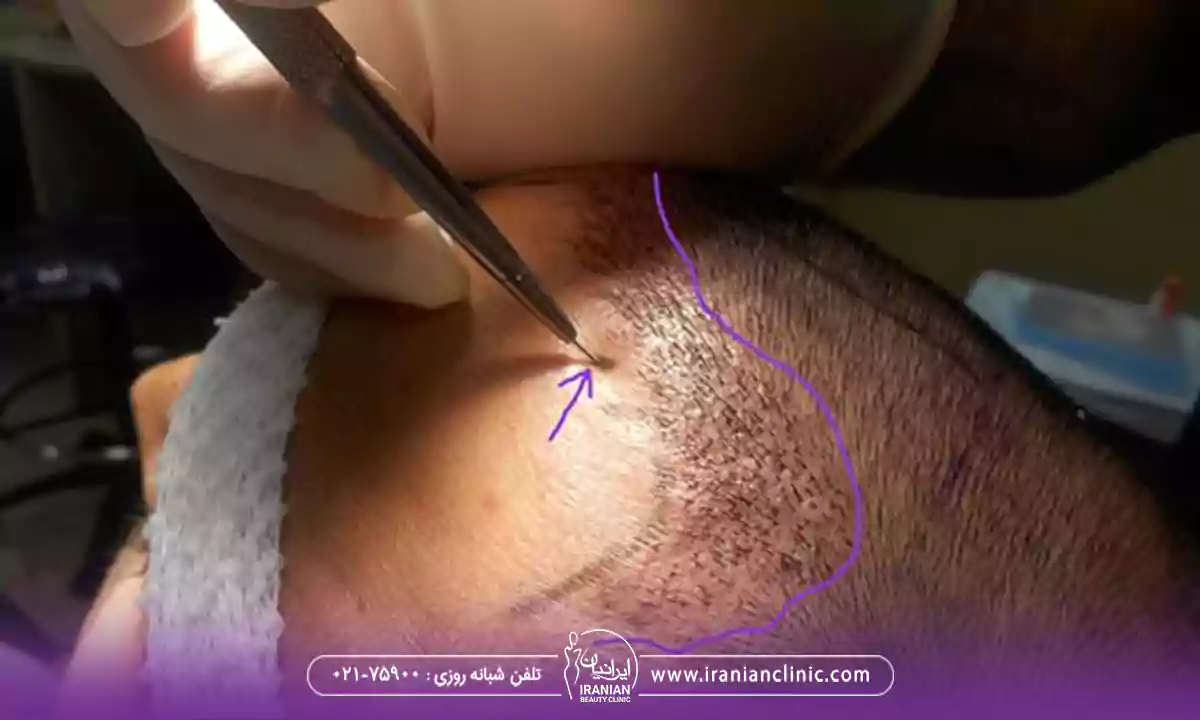 مهم ترین دلایل چربی سر بعد از کاشت مو
